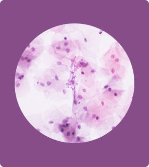 Candidiasis