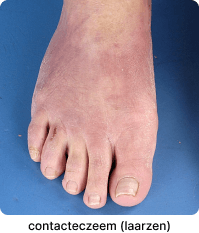 contact allergie in voet
