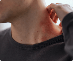 Man heeft een rash op zijn nek waaraan hij krabt