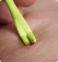 iemand wilt met een teken pen een teek van de huid afhalen