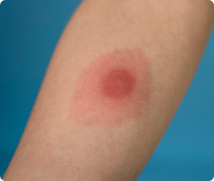 rooie kring op arm van een tekenbeet